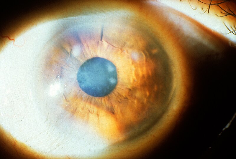 File:Subepithelial mucinous corneal dystrophy 1.JPEG