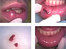 Surgical removal of a mucocele Surgical removal of a Mucocele..jpg