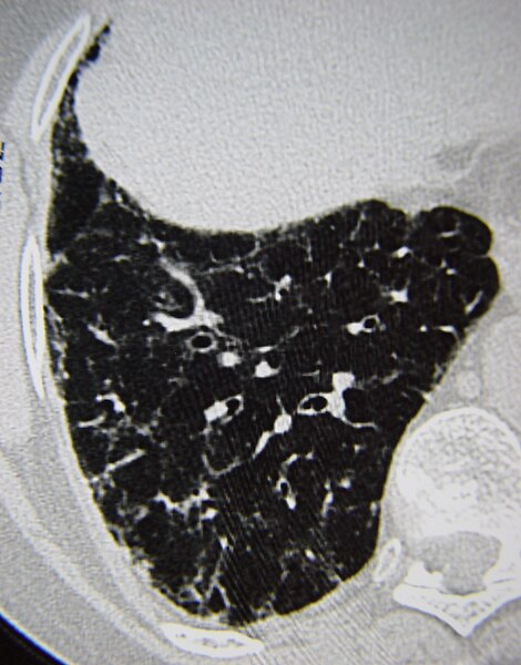 File:Systemic sclerosis case 03 pic 33 cr.jpg