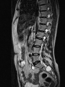 MRI sagittal image of sacral and dorso-lumbar perineural cysts.