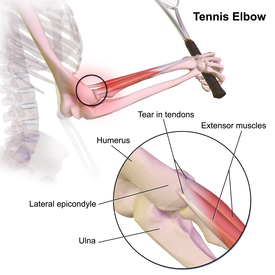 Tennis Elbow.png