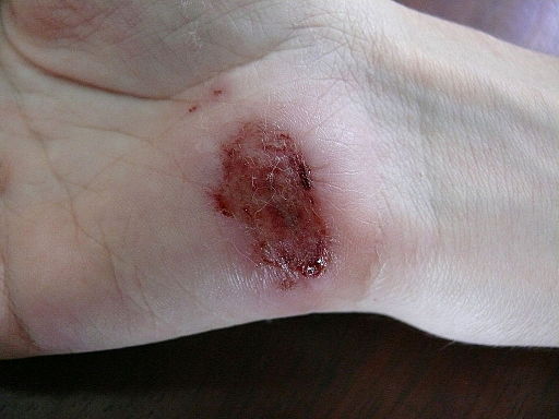Wound on palm of hand