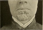 Thumbnail for File:A manual of syphilis and the venereal diseases, (1900) (14802374503).jpg