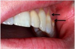 صورة تظهر آفات سنية غير نخرية على الحواف العنقية لمجموعة من الأسنان العلوية اليسرى