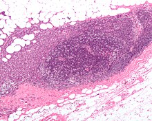 A micrograph showing an adenocarcinoma of the breast (dark pink) in a lymph node (purple) and extending into the surrounding fat (white, chicken-wire appearance). H&E stain. Breast carcinoma in a lymph node.jpg