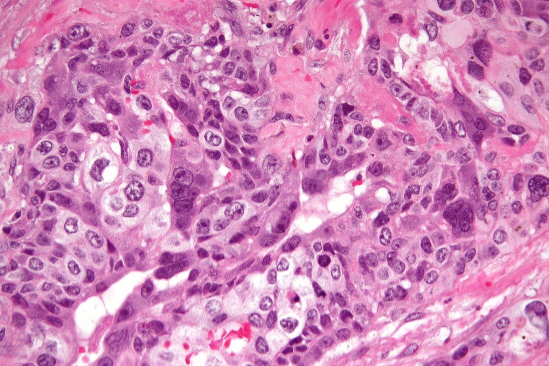 Coriocarcinoma