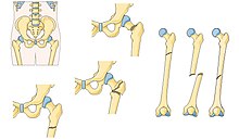 Common locations of fracture of femur Common fracture locations of femur.jpg