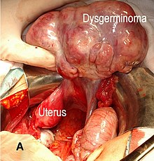 Excision of a dysgerminoma Dysgerminoma surgery.jpg