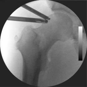 Figure 9. Intra-operative fluoroscopy image during arthroscopic resection of a cam lesion of the femur. The upper instrument is the arthroscope (viewing device), and the lower the high-speed burr (for reshaping the bone)..png