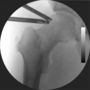 Thumbnail for Hip arthroscopy