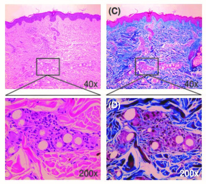 File:Induction-of-neocollagenesis-with-ellanse.jpg