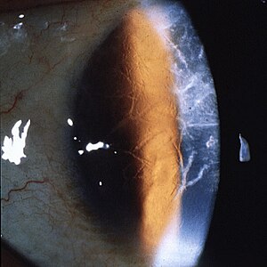 Lattice corneal dystrophy type 1.JPEG