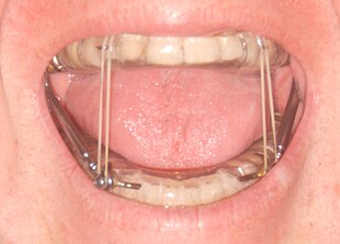 Mandibular advancement splint.jpg