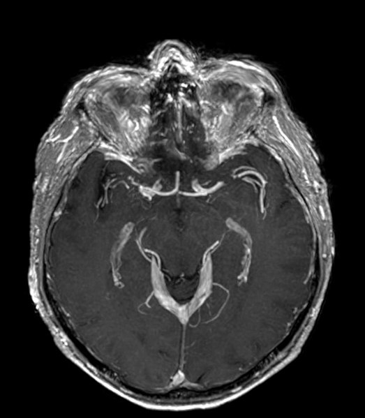 File:Persistierende Arteria trigemina 78M - MR T1 axial KM 8 mm MIP - 015.jpg