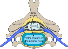 Polio spinal diagram-en.svg