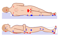 Pressure ulcer points.svg