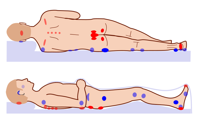 File:Pressure ulcer points.svg