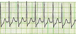 SVT Lead II-2.JPG