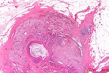 Micrograph of squamous metaplasia of lactiferous ducts. H&E stain. Squamous metaplasia of the lactiferous ducts - very low mag.jpg