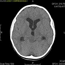 Axial non-contrast CT in a nine-year-old girl showing a slightly hypodense mass in the tectum of the brainstem, compressing the aqueduct of Sylvius and causing obstructive hydrocephalus Tectal plate glioma CT.jpg