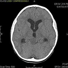 Axial non-contrast CT in a nine-year-old girl showing a slightly hypodense mass in the tectum of the brainstem, compressing the aqueduct of Sylvius and causing obstructive hydrocephalus