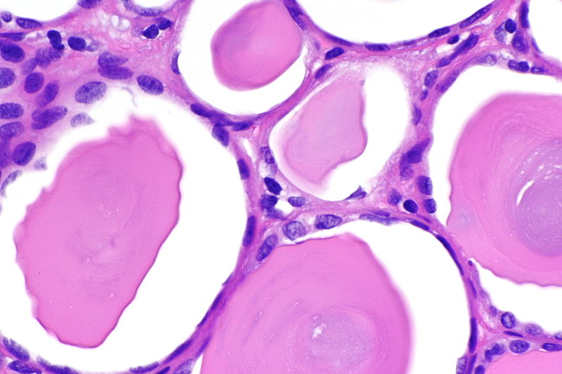 File:Thyroidization of the kidney - alt -- very high mag.jpg