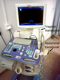 Thumbnail for Vaginal ultrasonography