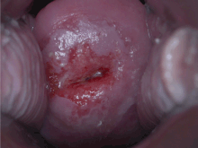 Positive visual inspection with acetic acid of the cervix for CIN-1 VIAPosCIN1.gif