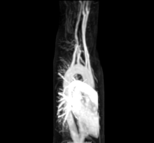 Arteria-lusoria MRA MIP.gif