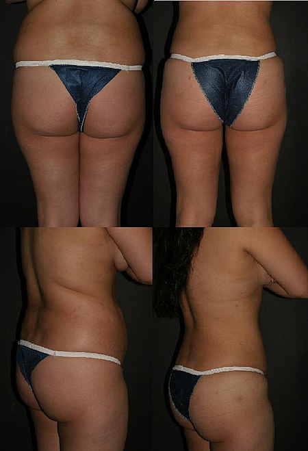 Buttock Augmentation Before & After.JPG