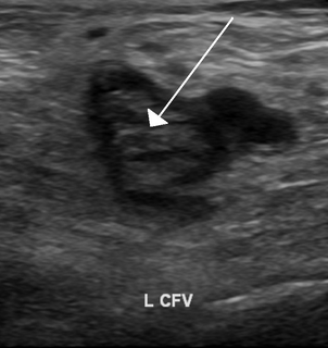 Ultrasonography of deep vein thrombosis