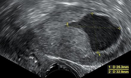 Vaginal ultrasonography with an endometrial fluid accumulation (darker area) in a postmenopausal uterus, a finding that is highly suspicious for endometrial cancer