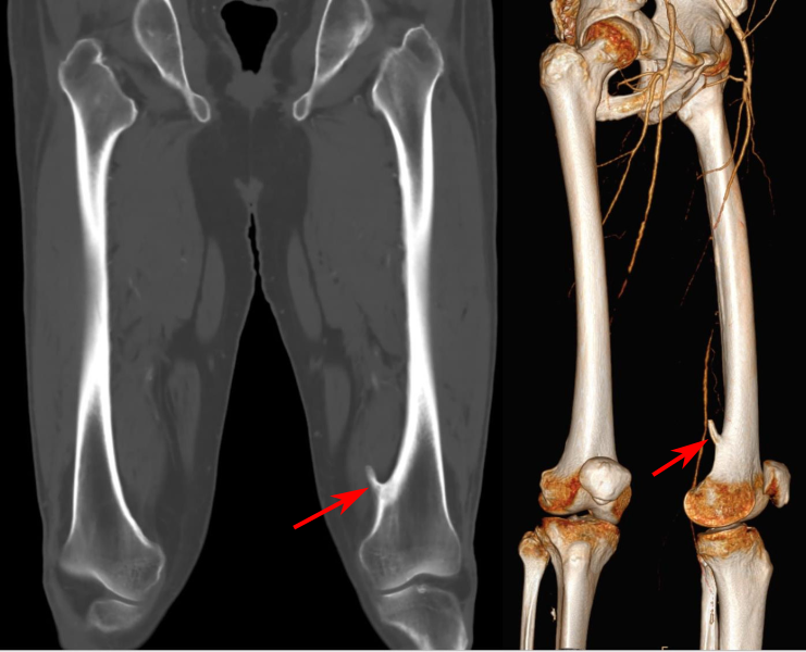 File:Exostose Femur 54jm- CT cor und VR - 001.svg