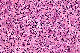 Micrografía de células gigantes de hueso de osteoblastoclastoma, las células gigantes se destacan de forma característica.  Teñido con hematoxilina y eosina.