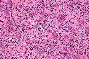 Giant cell tumour of bone - high mag.jpg