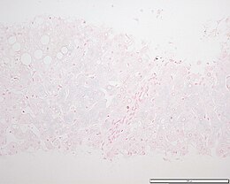 Description de l'image Hemochromatosis liver section.JPG.