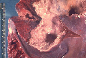 Liver containing amebic abscess, gross pathology 3MG0042 lores.jpg