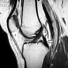 MRI snimak normalanog ukrštenog ligamenta (strelice).