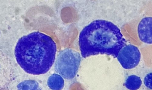 Mast cells in bone marrow.jpg
