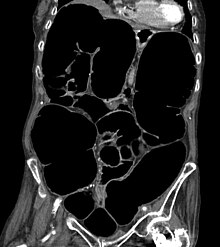 Ogilvie ct coronal.jpg