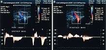 Parana maneuver: checking perforators Parana maneuver2.jpg