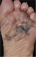 Photography of a large acral lentiginous melanoma.jpg