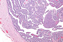 Micrograph of salpingitis - a component of pelvic inflammatory disease. H&E stain. Salpingitis - low mag.jpg