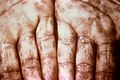 Triệu chứng của bệnh giang mai giai đoạn 2 ở lòng bàn tay.
