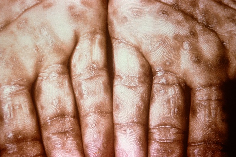 File:Secondary Syphilis on palms CDC 6809 lores.rsh.jpg