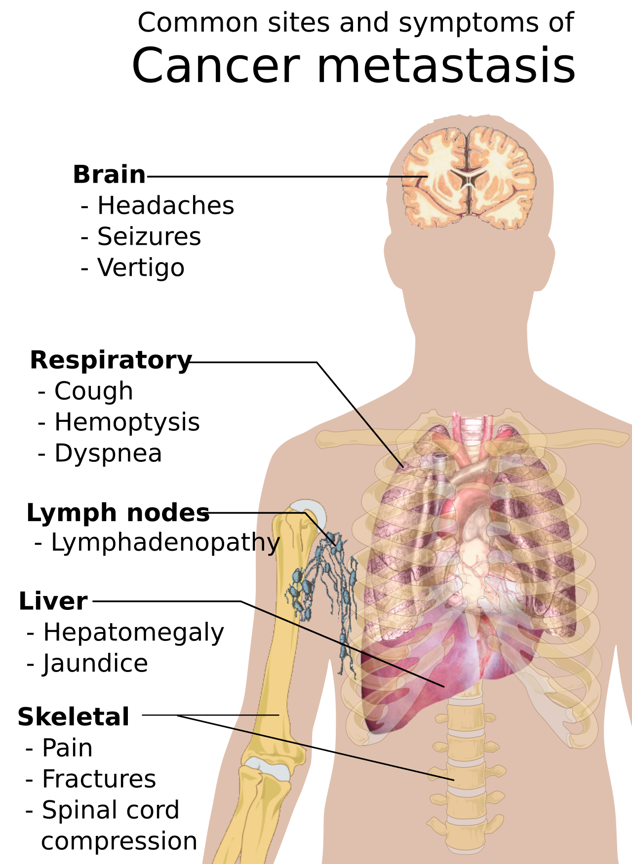 Main symptoms of cancer metastasis. Sources are found in main article: Wikipedia:By Mikael Häggström.When using this image in external works, it may be cited as:Häggström, Mikael (2014). 