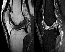 Anterior cruciate ligament tear seen on MRI. T1 left, right PDW. VKB-Riss MRT T1 PDW sag.jpg