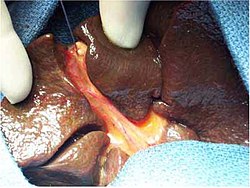 منظر جراحي لرتق كامل للقناة الصفراوية خارج الكبد[1]