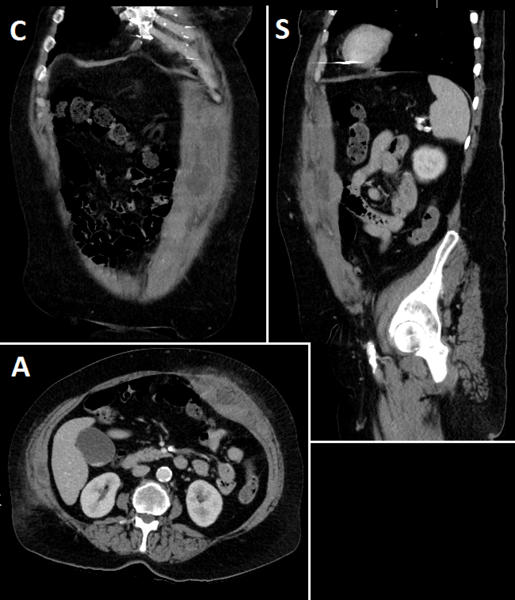 File:CT of rectus sheath hematomas.png