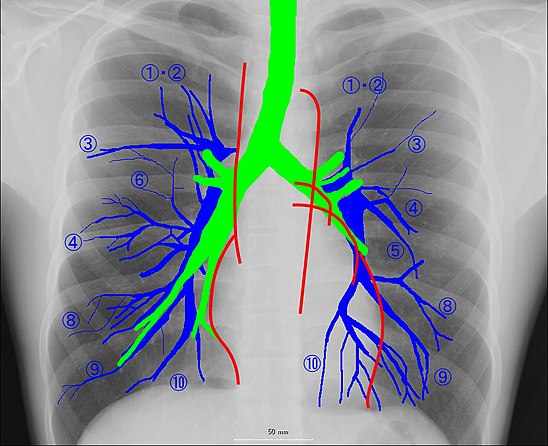 Легочный сосудистый рисунок. Легочная артерия анатомия. Рентген легких анатомия. Ветви легочной артерии анатомия. Сегменты легочной артерии кт.